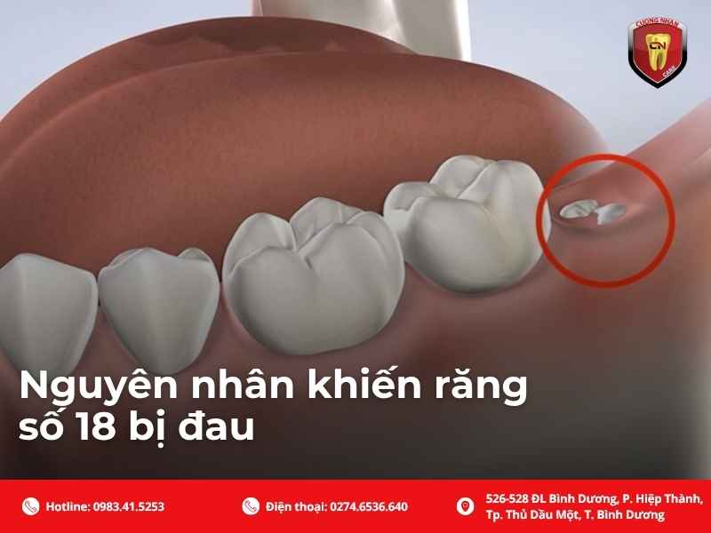 Nguyên nhân khiến răng số 18 bị đau