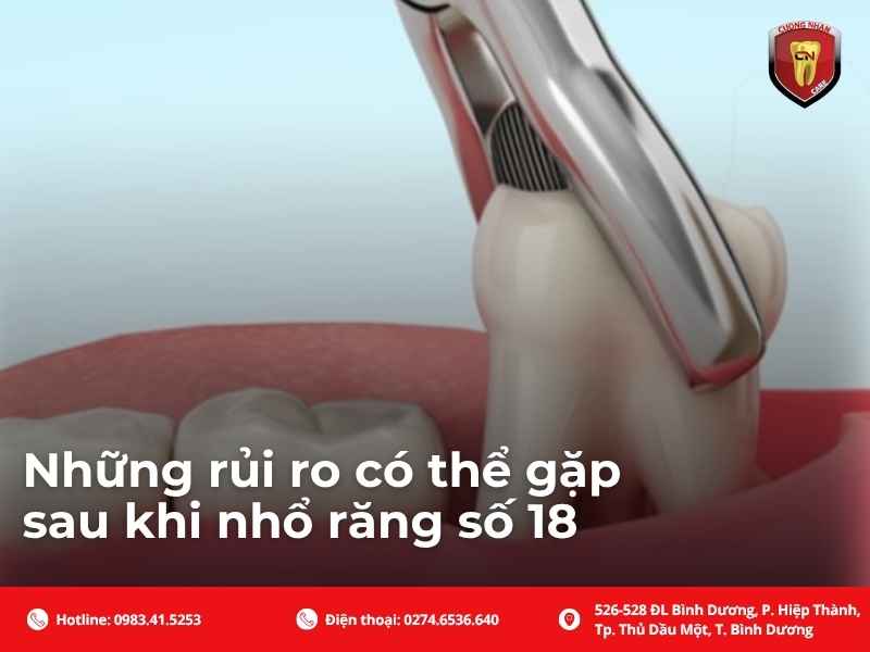 Nhổ răng số 18 có nguy hiểm không?