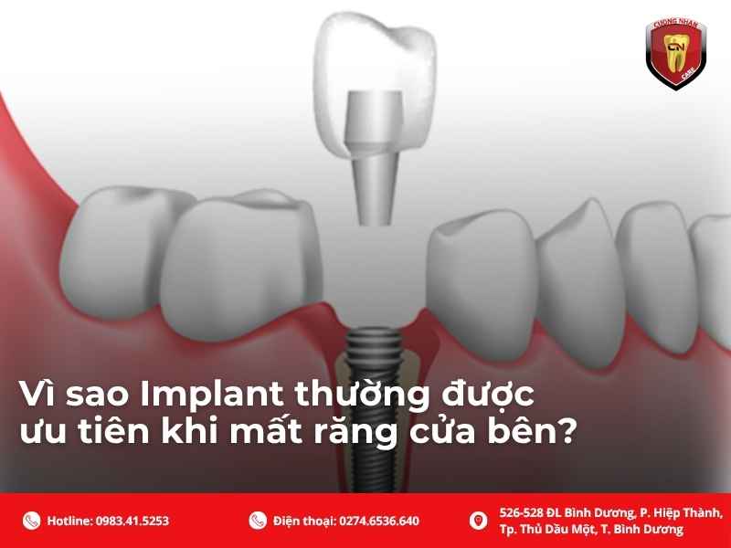Các phương pháp phục hồi răng số 2 hiện nay