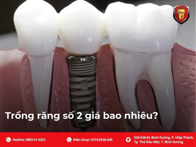 Vì sao Implant thường được ưu tiên khi mất răng cửa bên?