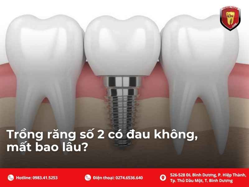 Trồng răng số 2 giá bao nhiêu?