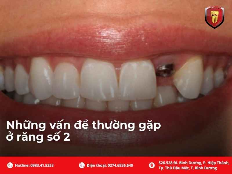 Chức năng của răng số 2 không chỉ dừng ở ăn nhai