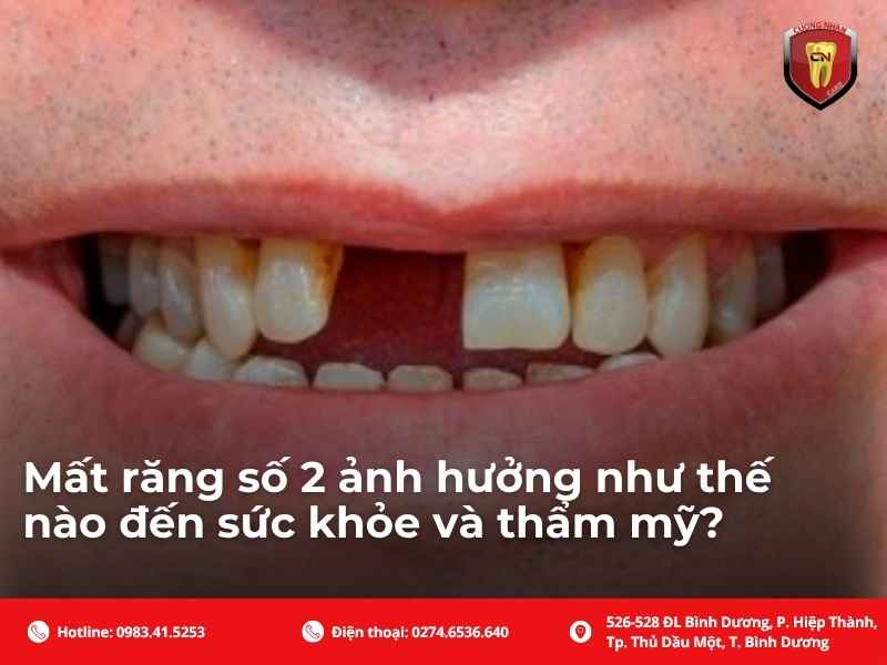 Khi nào nên giữ lại, khi nào cần nhổ răng số 2?
