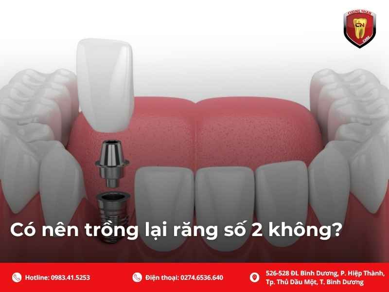 Mất răng số 2 ảnh hưởng như thế nào đến sức khỏe và thẩm mỹ?