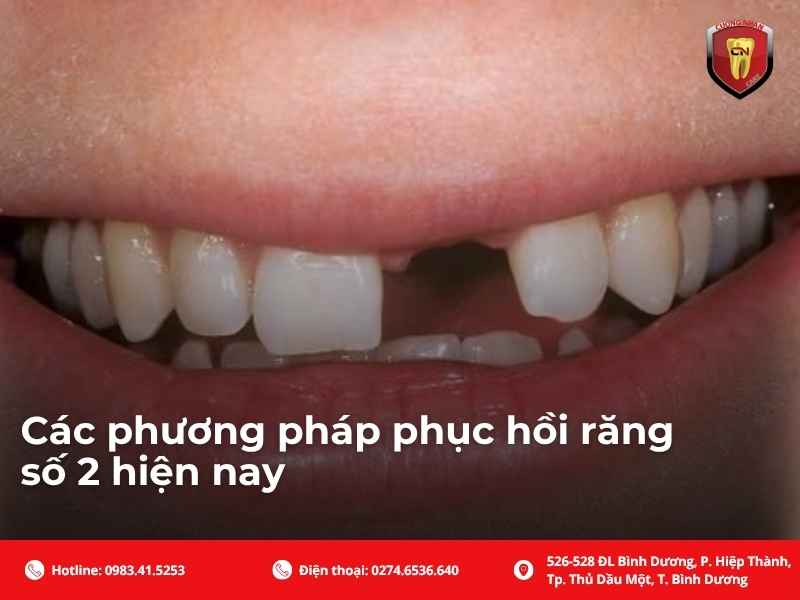Có nên trồng lại răng số 2 không?