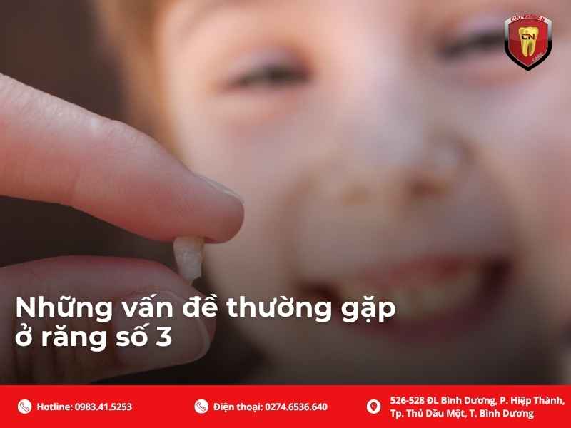 Những vấn đề thường gặp ở răng số 3
