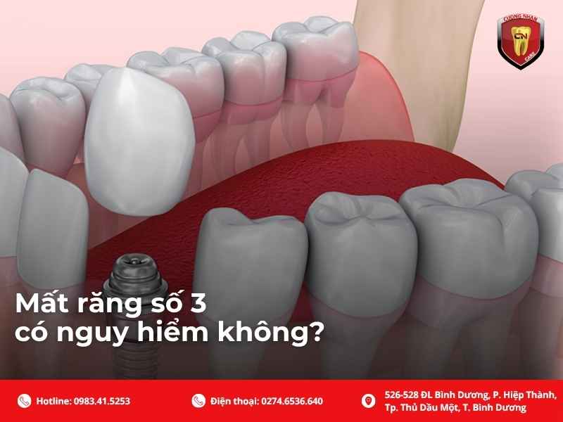 Mất răng số 3 có nguy hiểm không?