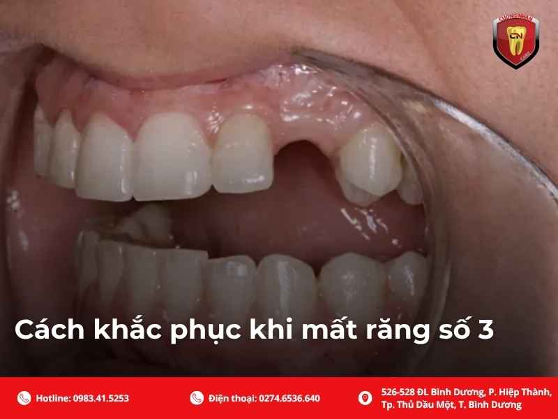 Cách khắc phục khi mất răng số 3