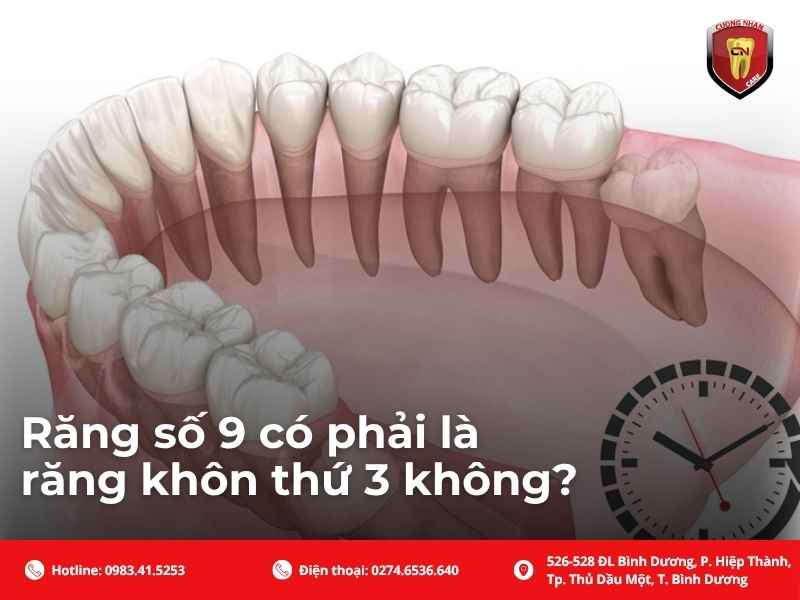 Răng số 9 có phải là răng khôn thứ 3 không?