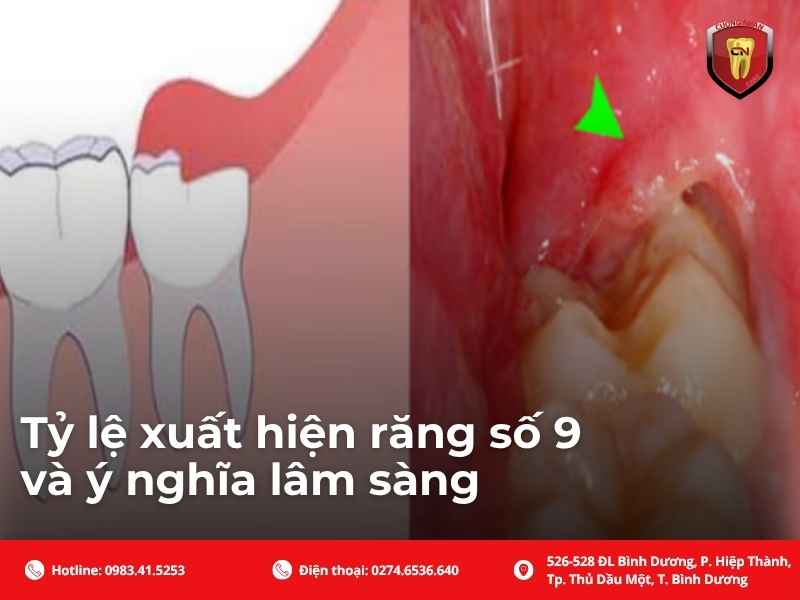Tỷ lệ xuất hiện răng số 9 và ý nghĩa lâm sàng