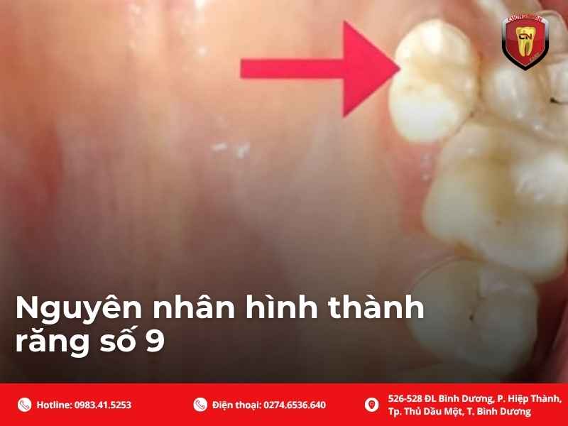 Nguyên nhân hình thành răng số 9