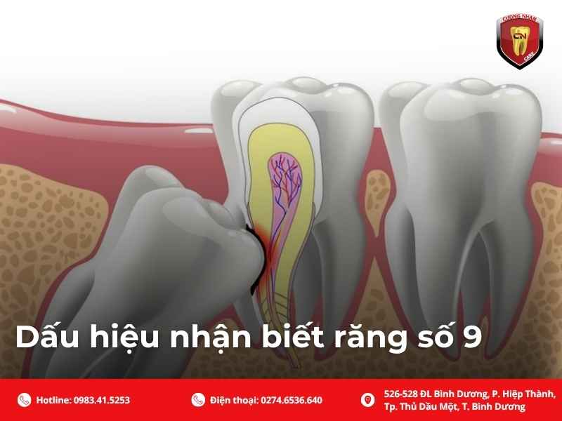 Dấu hiệu nhận biết răng số 9