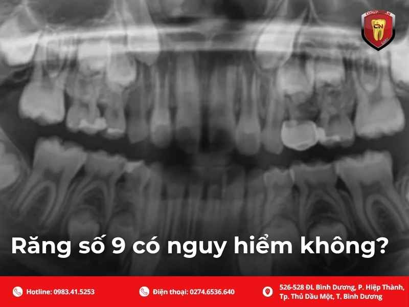 Răng số 9 có nguy hiểm không?