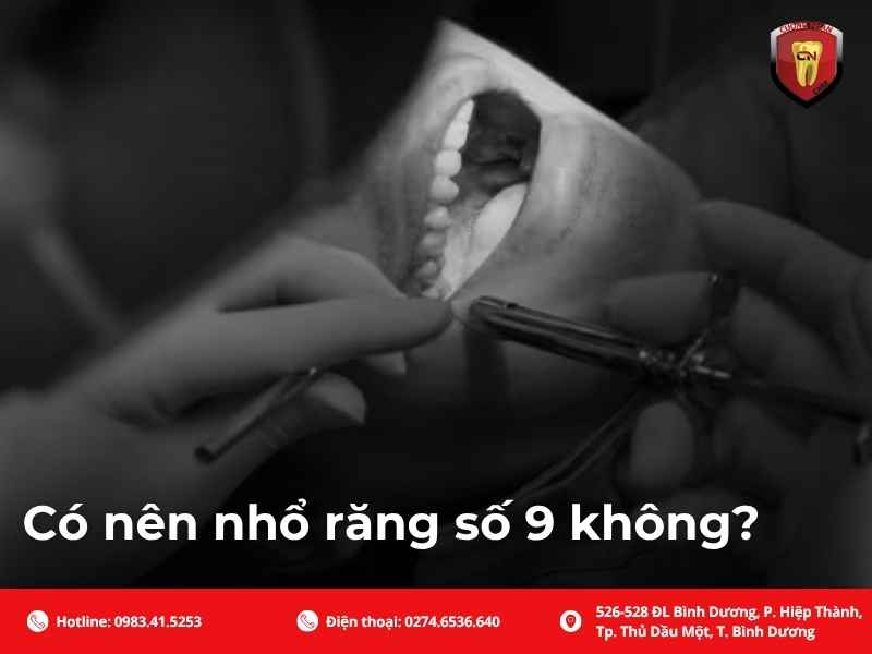 Có nên nhổ răng số 9 không?