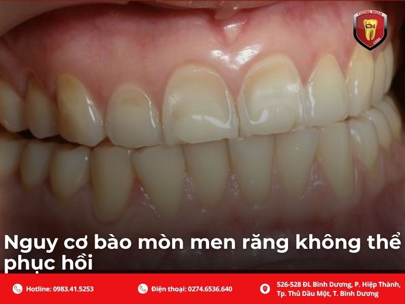 Nguy cơ bào mòn men răng không thể phục hồi