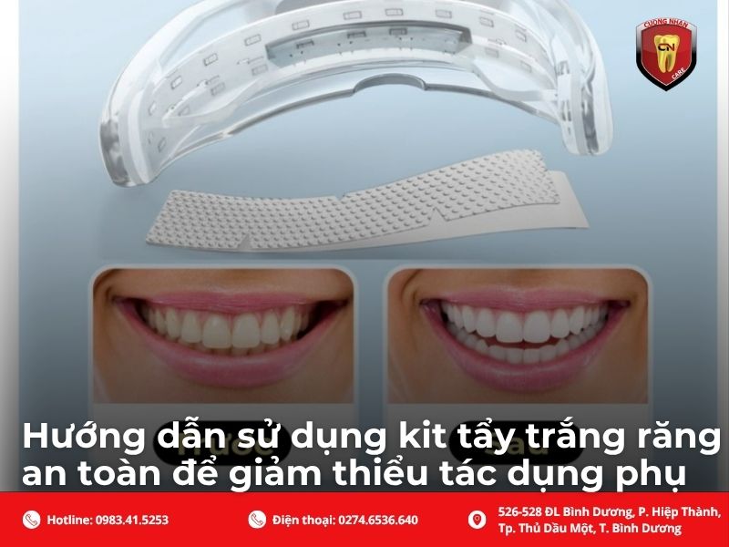 Hướng dẫn sử dụng kit tẩy trắng răng an toàn để giảm thiểu tác dụng phụ