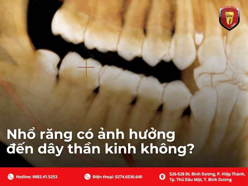 Nhổ răng có ảnh hưởng đến dây thần kinh không?