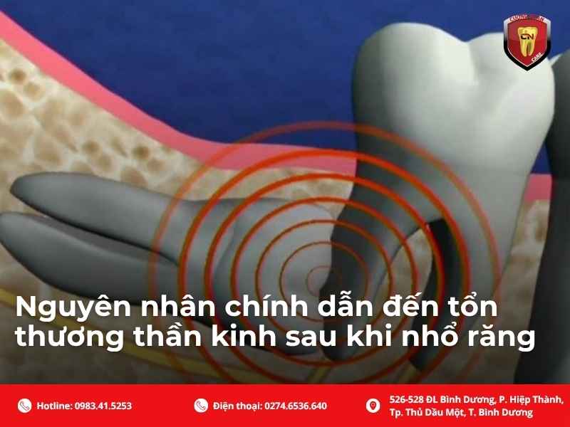 Nguyên nhân chính dẫn đến tổn thương thần kinh sau khi nhổ răng