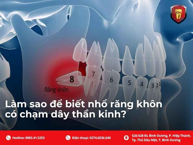 Làm sao để biết nhổ răng khôn có chạm dây thần kinh?