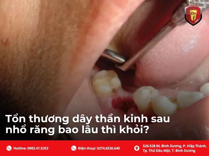 Tổn thương dây thần kinh sau nhổ răng bao lâu thì khỏi?