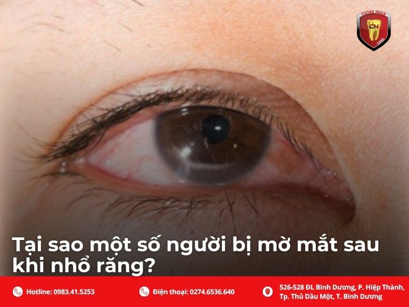 Tại sao một số người bị mờ mắt sau khi nhổ răng?