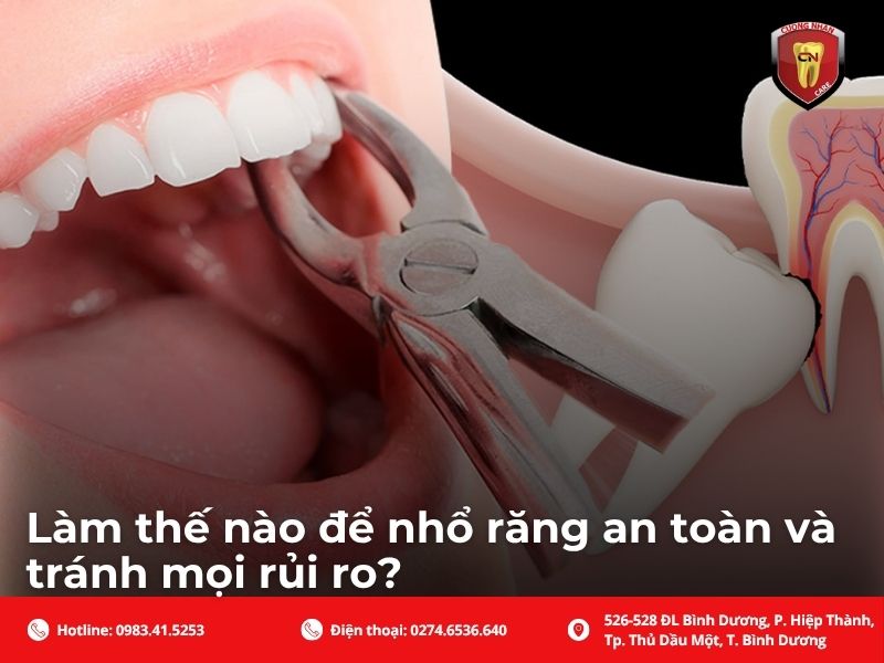 Làm thế nào để nhổ răng an toàn và tránh mọi rủi ro?