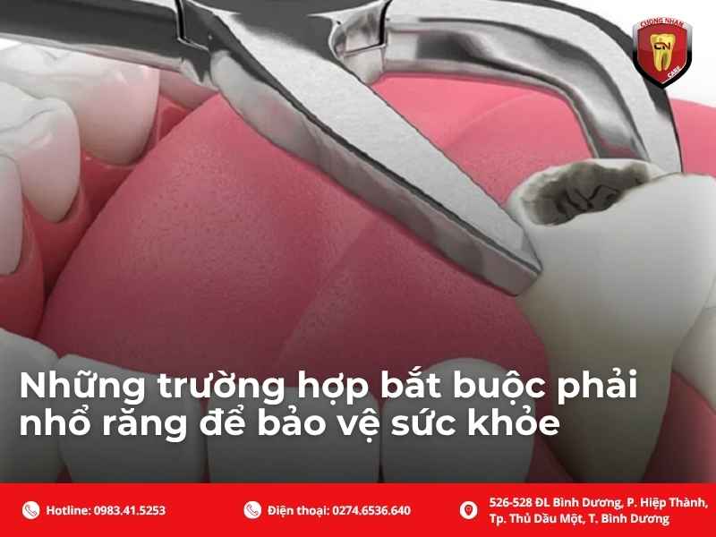 Những trường hợp bắt buộc phải nhổ răng để bảo vệ sức khỏe