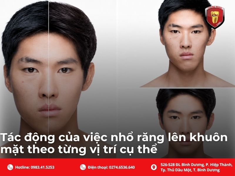 Tác động của việc nhổ răng lên khuôn mặt theo từng vị trí cụ thể