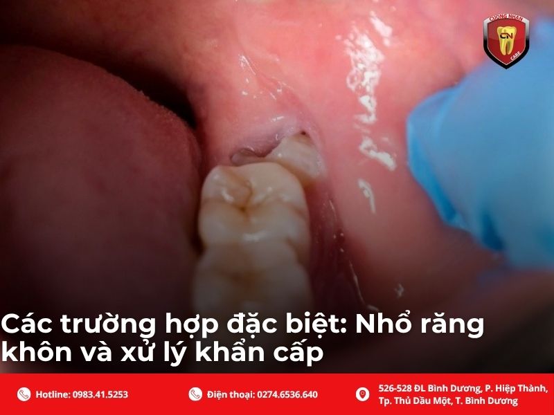 Các trường hợp đặc biệt: Nhổ răng khôn và xử lý khẩn cấp