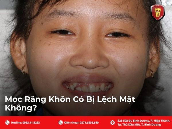 Mọc răng khôn có bị lệch mặt không?