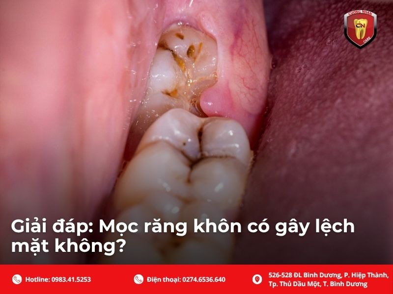 Phân biệt giữa sưng má tạm thời và lệch mặt vĩnh viễn