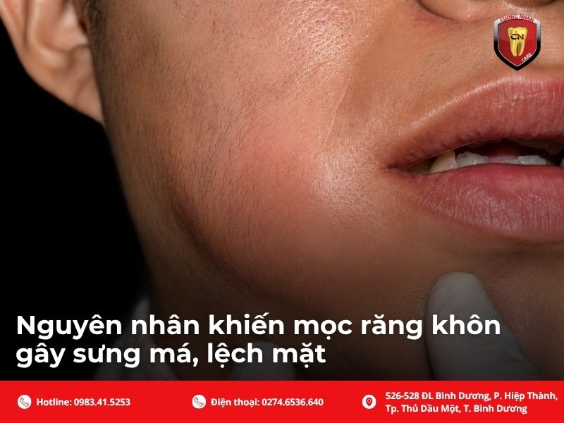 Nguyên nhân khiến mọc răng khôn gây sưng má, lệch mặt