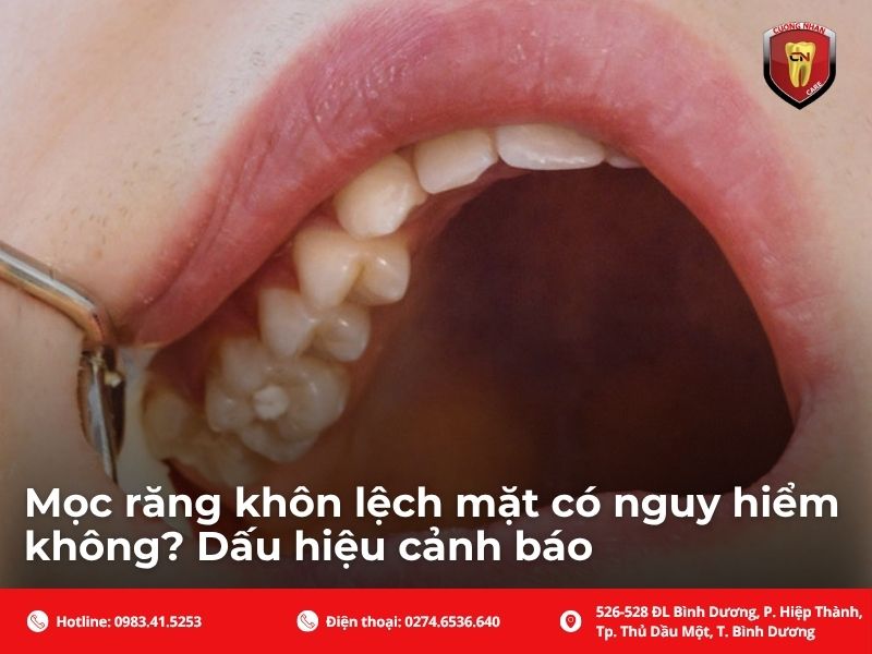 Mọc răng khôn lệch mặt có nguy hiểm không? Dấu hiệu cảnh báo