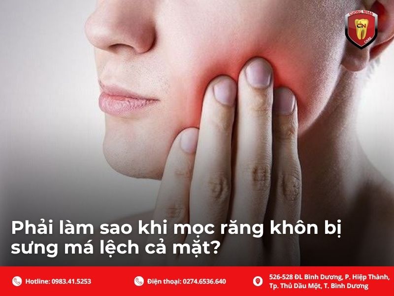 Phải làm sao khi mọc răng khôn bị sưng má lệch cả mặt?
