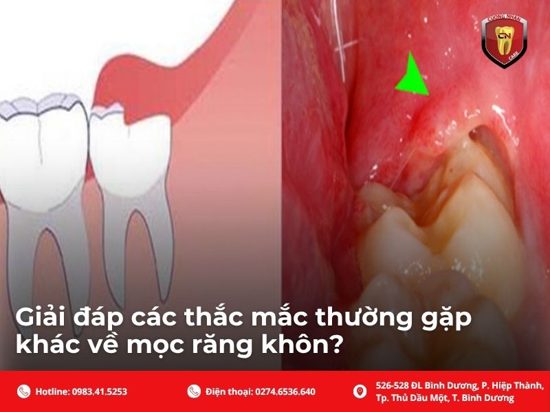 Giải đáp các thắc mắc thường gặp khác về mọc răng khôn?