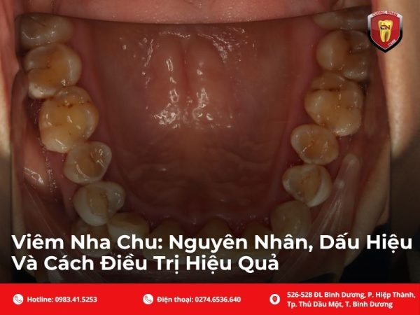 Để hiểu rõ về bệnh lý này, trước hết chúng ta cần phân biệt rạch ròi giữa viêm nướu và viêm nha chu. Nhiều người thường nhầm lẫn hai khái niệm này, nhưng thực chất chúng đại diện cho hai giai đoạn của cùng một quá trình bệnh lý với mức độ nghiêm trọng hoàn toàn khác nhau.