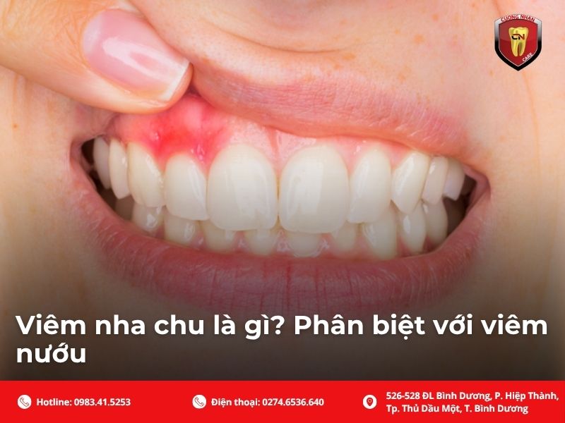 Viêm nha chu là gì? Phân biệt với viêm nướu