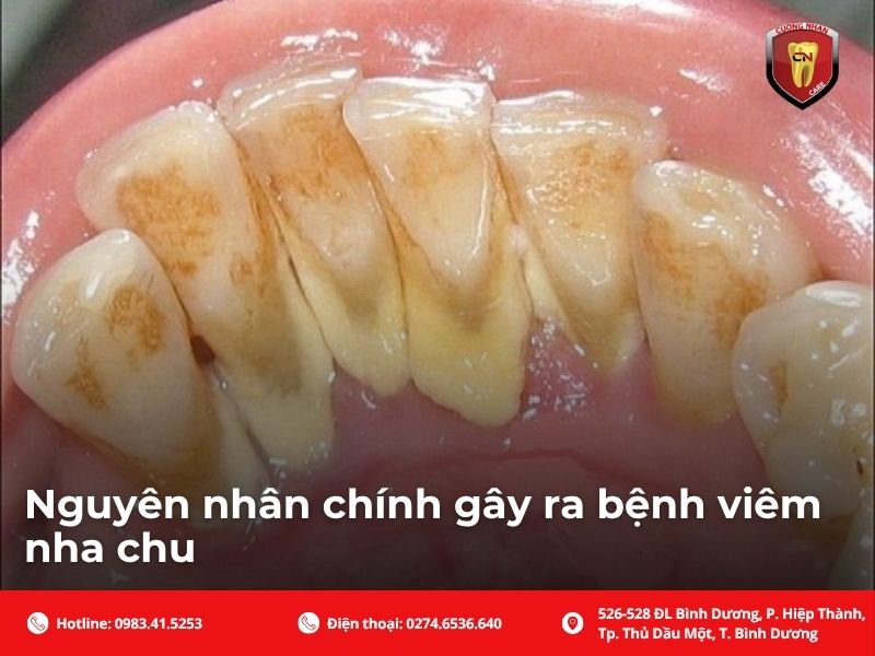 Viêm nha chu là gì? Phân biệt với viêm nướu