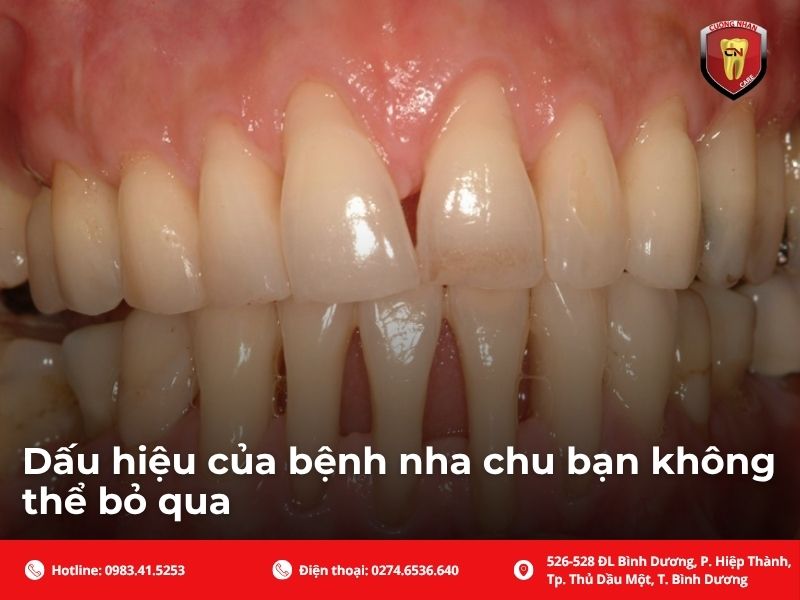 Nguyên nhân chính gây ra bệnh viêm nha chu