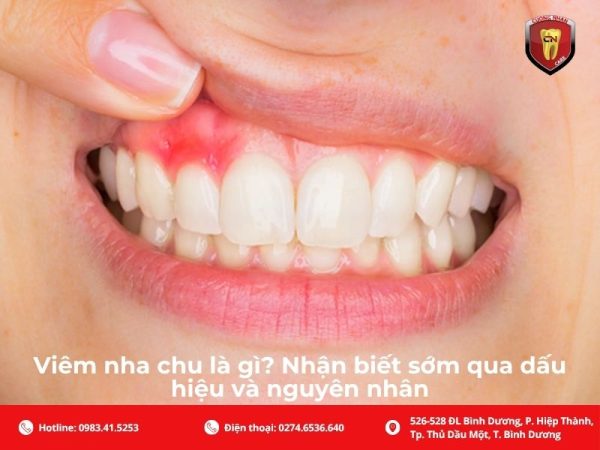 Viêm nha chu là gì? Nhận biết sớm qua dấu hiệu và nguyên nhân