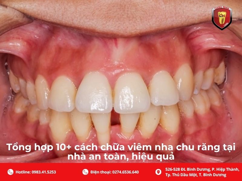Tổng hợp 10+ cách chữa viêm nha chu răng tại nhà an toàn, hiệu quả