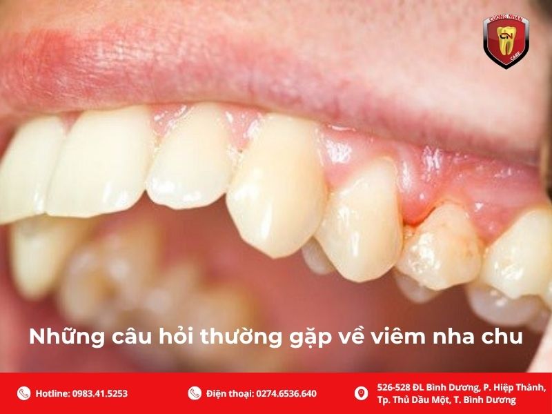 Những câu hỏi thường gặp về viêm nha chu