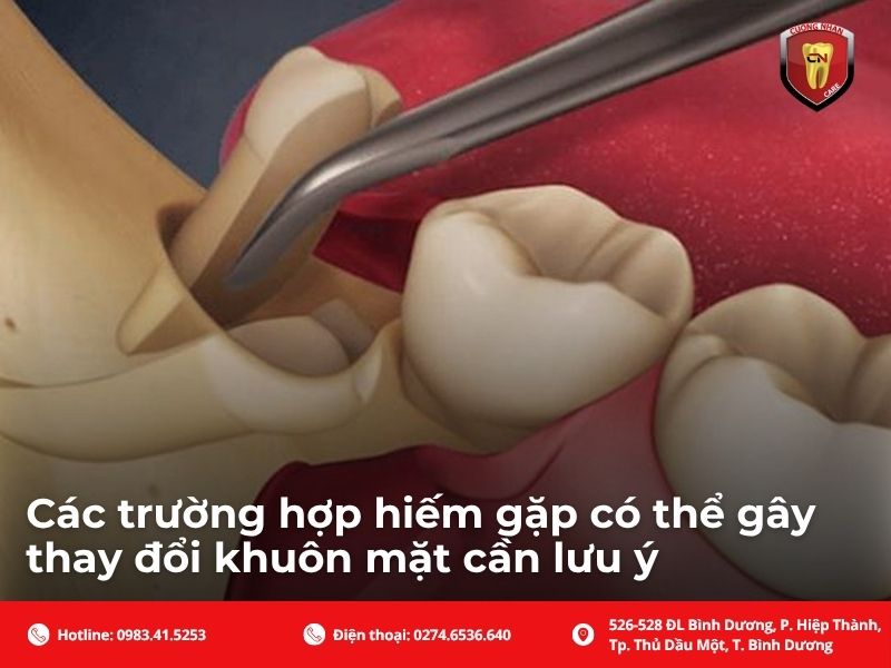 Liệu nhổ răng khôn có bị hóp má không