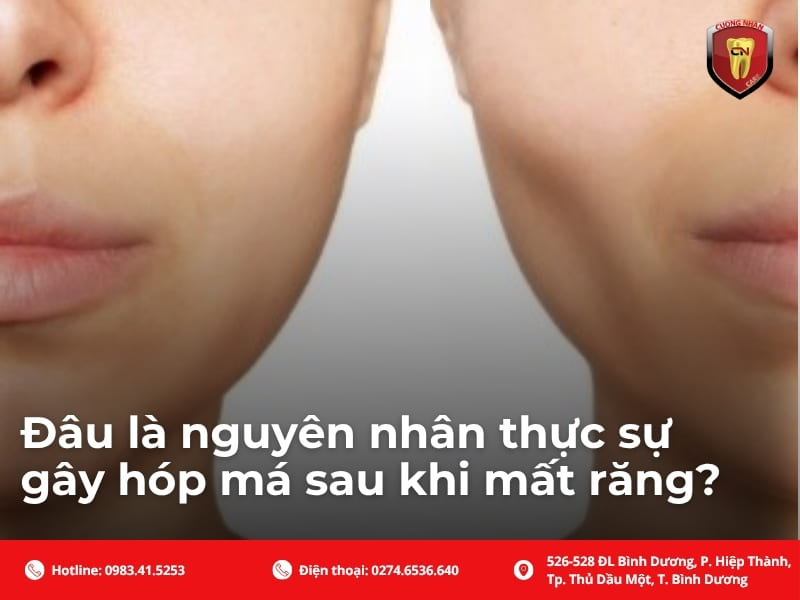 Đâu là nguyên nhân thực sự gây hóp má sau khi mất răng?