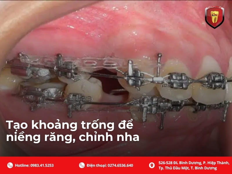 Tạo khoảng trống để niềng răng, chỉnh nha