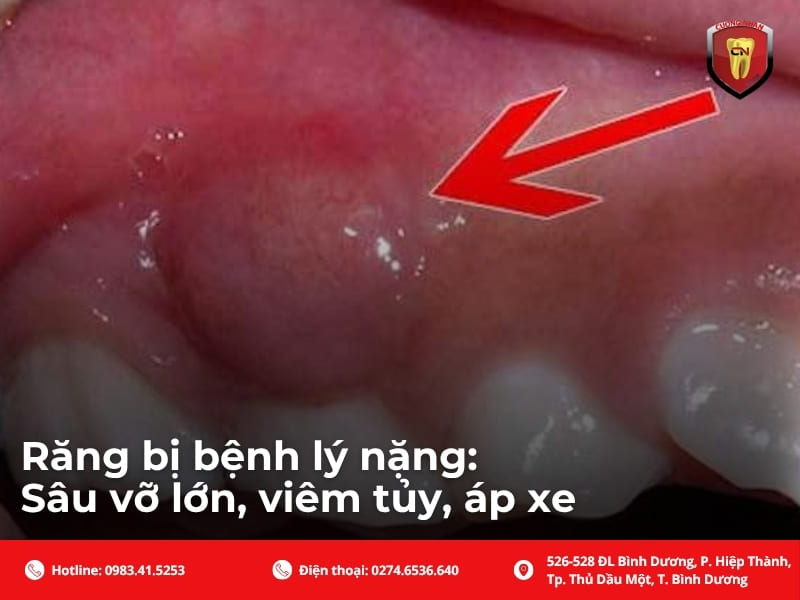 Răng bị bệnh lý nặng