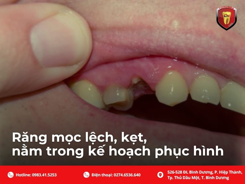 Răng mọc lệch, kẹt, nằm trong kế hoạch phục hình