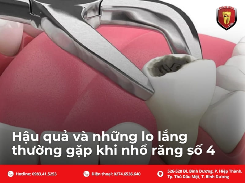 Hậu quả và những lo lắng thường gặp khi nhổ răng số 4