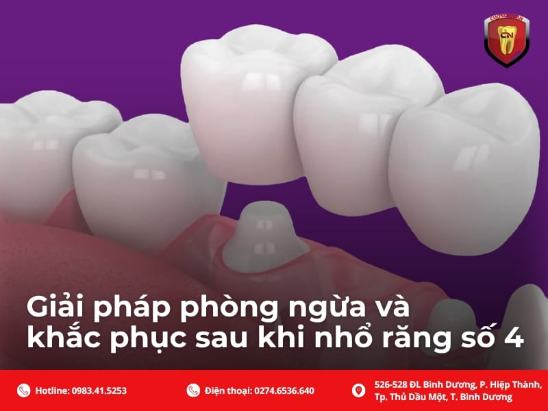 Giải pháp phòng ngừa và khắc phục sau khi nhổ răng số 4