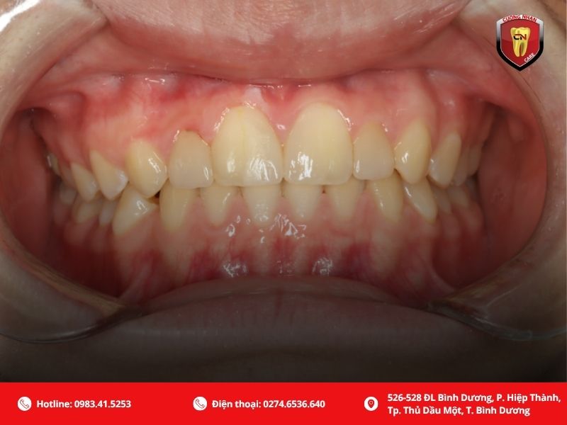 Nhổ răng số 5 có đau và nguy hiểm không?